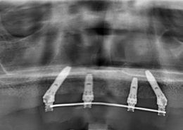 Рентгенограмма с несъемной временной конструкцией на 4-х имплантатах, два из которых расположены под углом