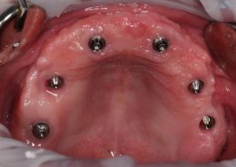 Имплантаты в полости рта