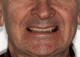 Металлокерамические "зубы"