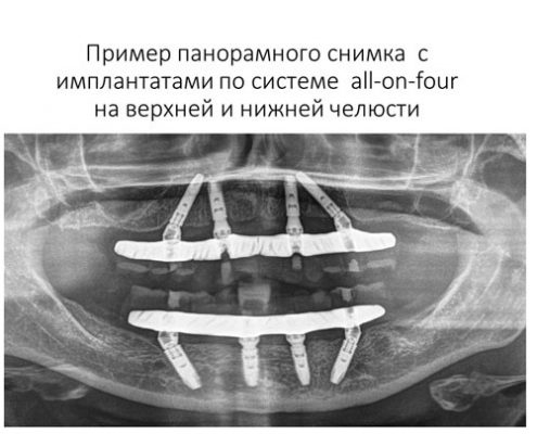 Протезирование по системе all-on-four Протезирование по системе all-on-four