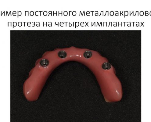Протезирование по системе all-on-four Протезирование по системе all-on-four