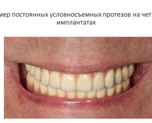 Протезирование по системе all-on-four Протезирование по системе all-on-four
