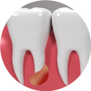 3d-render-teeth-with-wisdom-mesial-impaction