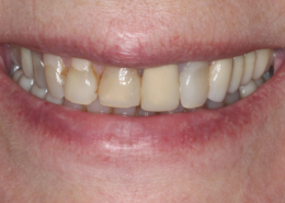восстановление зубов диоксидом циркония